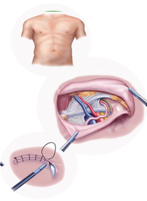 Combating Hernia