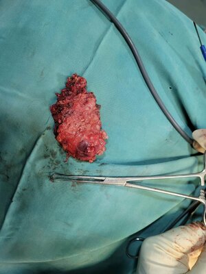 Mini Gastric Bypass For Morbid Obesity in Pune Dr. Sameer Badani