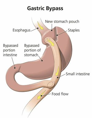Gastric Bypass - Dr. Sameer Badami